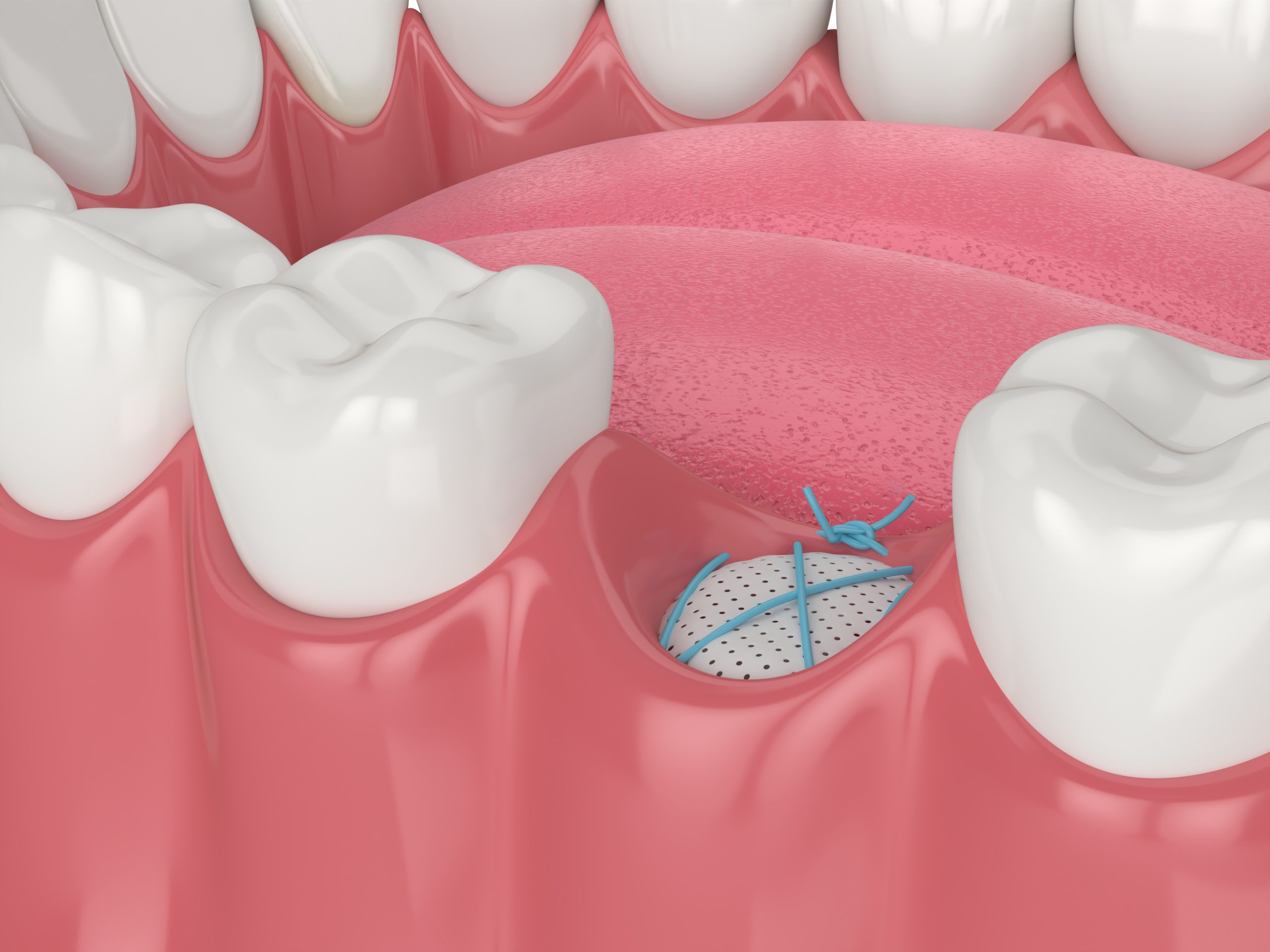 Bone Grafting Cost Estimate Budgeting Tips